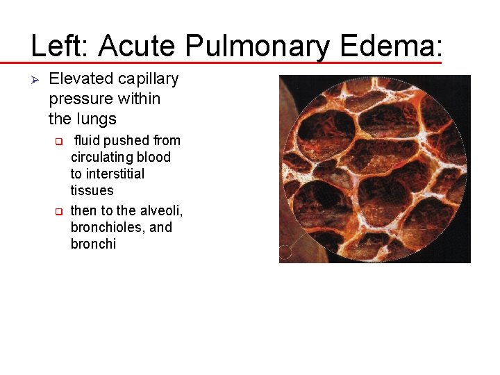 Left: Acute Pulmonary Edema: Ø Elevated capillary pressure within the lungs q q fluid