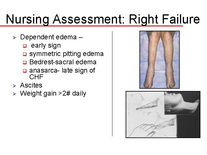 Nursing Assessment: Right Failure Ø Ø Ø Dependent edema – q early sign q