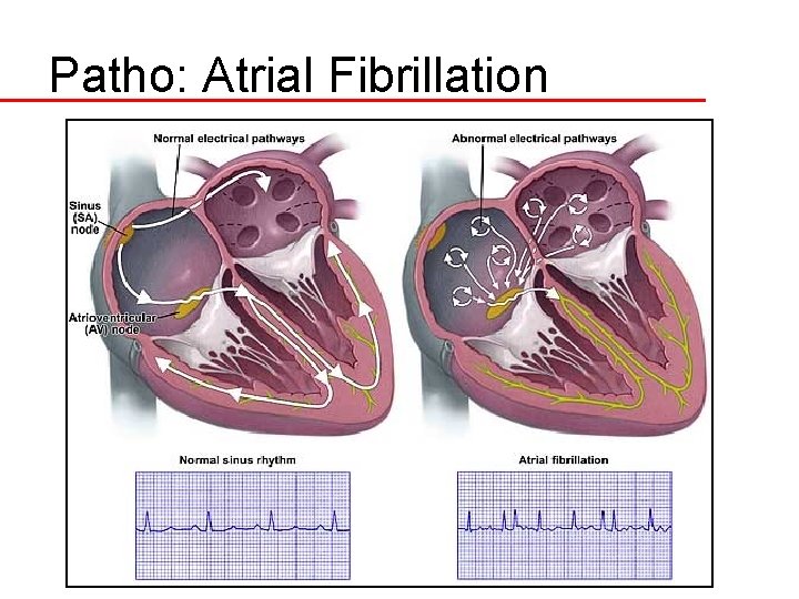 Patho: Atrial Fibrillation 