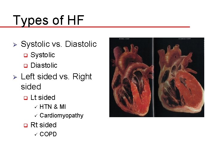 Types of HF Ø Systolic vs. Diastolic Systolic q Diastolic q Ø Left sided