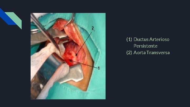(1) Ductus Arterioso Persistente (2) Aorta Transversa 