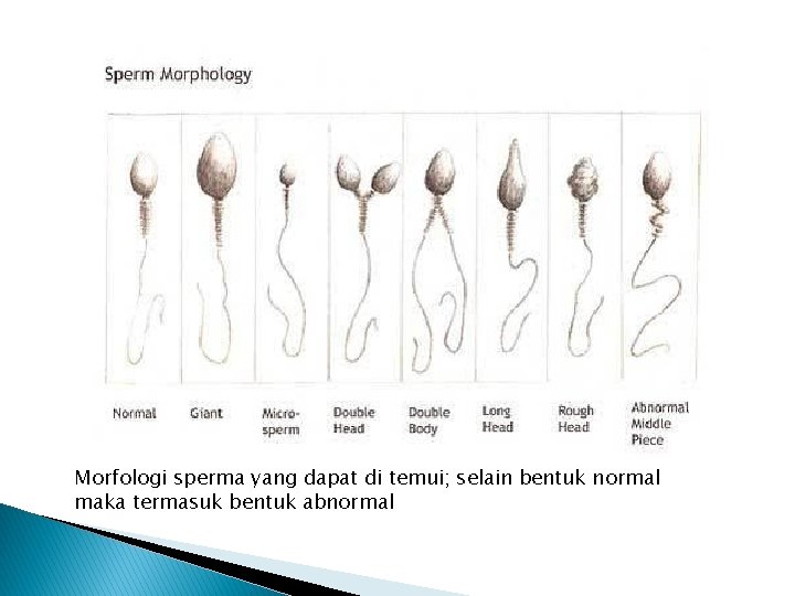 Morfologi sperma yang dapat di temui; selain bentuk normal maka termasuk bentuk abnormal 