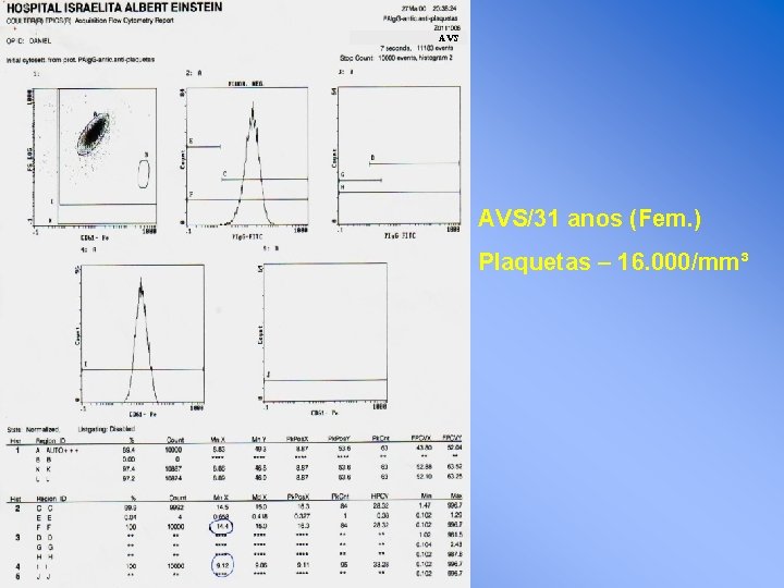 AVS AVS/31 anos (Fem. ) Plaquetas – 16. 000/mm³ 