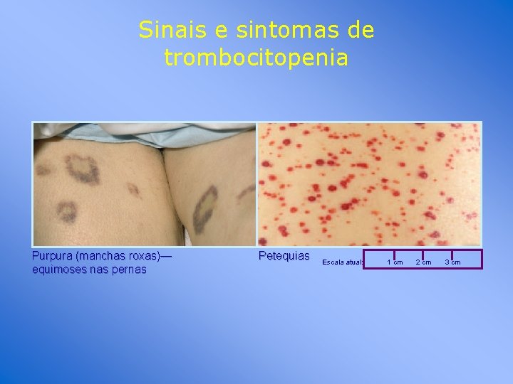 Sinais e sintomas de trombocitopenia Purpura (manchas roxas)— equimoses nas pernas Petequias Escala atual: