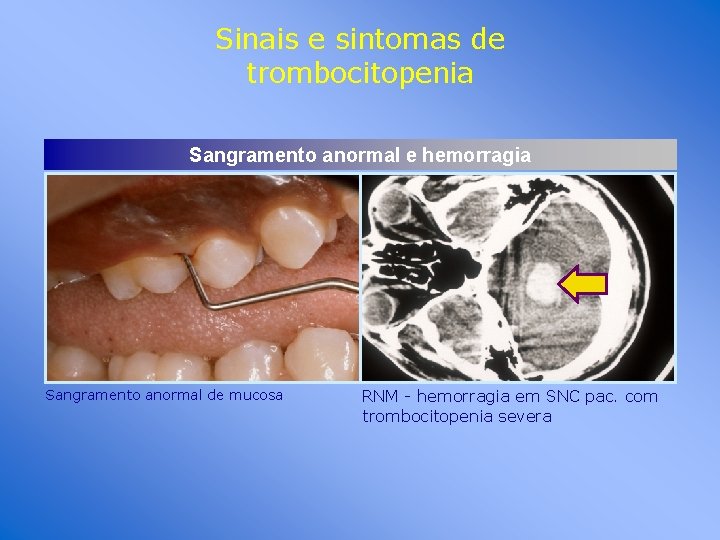 Sinais e sintomas de trombocitopenia Sangramento anormal e hemorragia Sangramento anormal de mucosa RNM