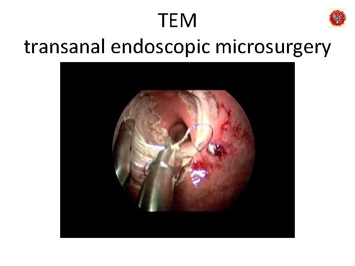 TEM transanal endoscopic microsurgery 