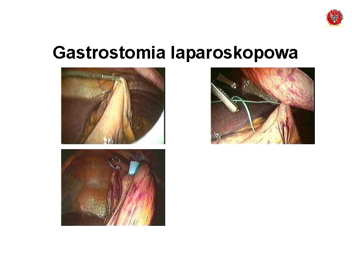 Gastrostomia laparoskopowa 