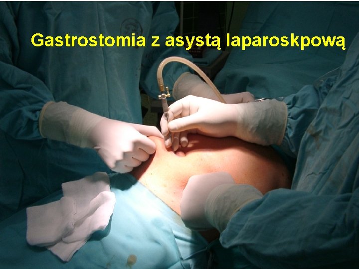 Gastrostomia z asystą laparoskpową 