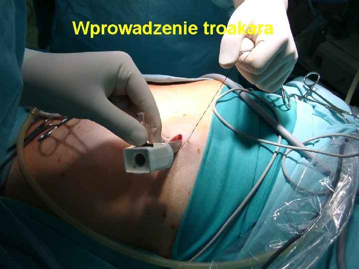 Wprowadzenie troakara 