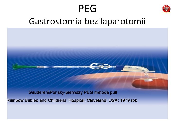 PEG Gastrostomia bez laparotomii Gauderer&Ponsky-pierwszy PEG metodą pull Rainbow Babies and Childrens’ Hospital, Cleveland;