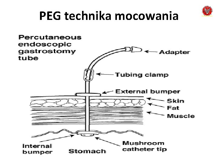 PEG technika mocowania 