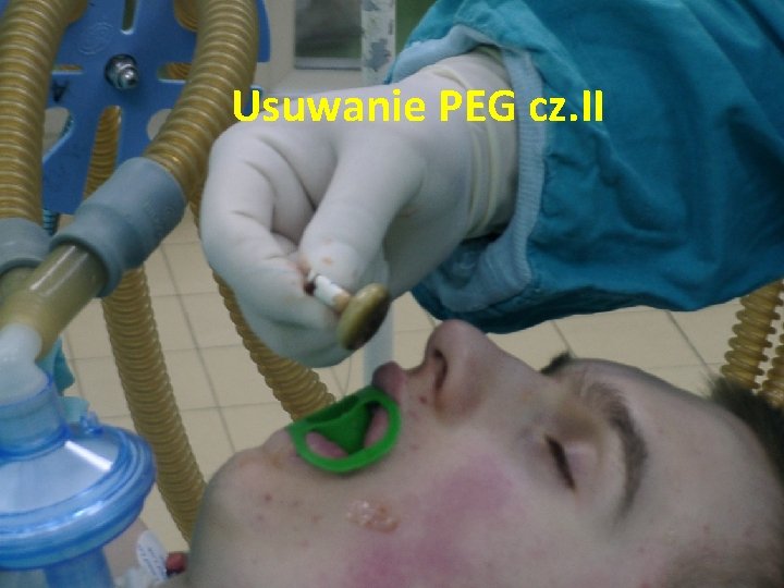 Usuwanie PEG cz. II 