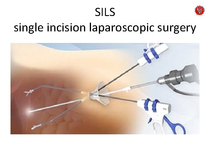 SILS single incision laparoscopic surgery 