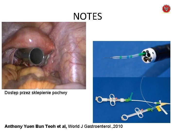 NOTES Dostęp przez sklepienie pochwy Anthony Yuen Bun Teoh et al, World J Gastroenterol.