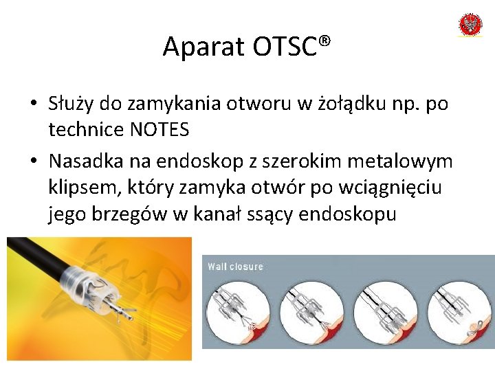 Aparat OTSC® • Służy do zamykania otworu w żołądku np. po technice NOTES •