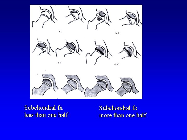 Subchondral fx less than one half Subchondral fx more than one half 