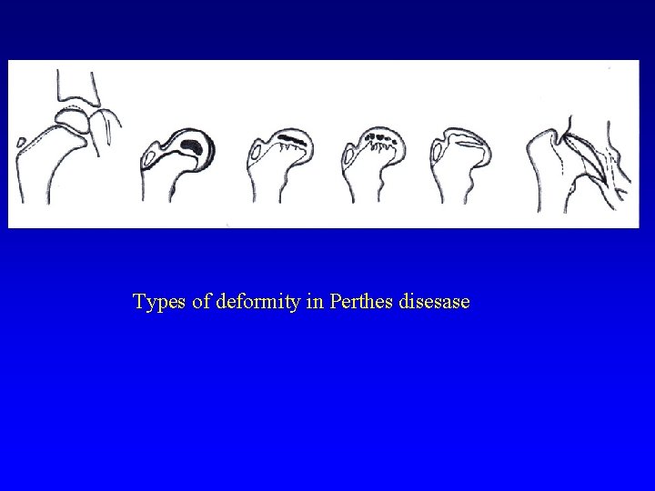 Types of deformity in Perthes disesase 