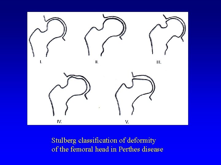 Stulberg classification of deformity of the femoral head in Perthes disease 