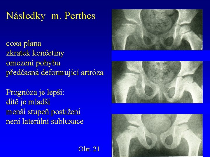 Následky m. Perthes coxa plana zkratek končetiny omezení pohybu předčasná deformující artróza Prognóza je