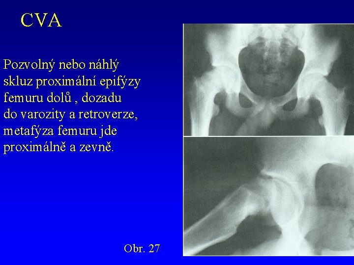CVA Pozvolný nebo náhlý skluz proximální epifýzy femuru dolů , dozadu do varozity a