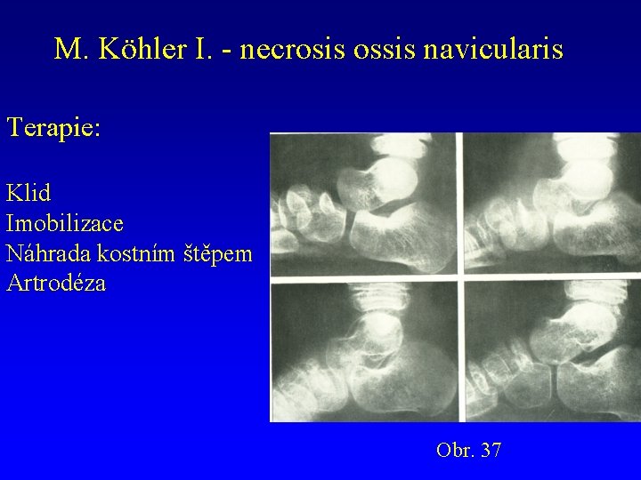 M. Köhler I. - necrosis ossis navicularis Terapie: Klid Imobilizace Náhrada kostním štěpem Artrodéza