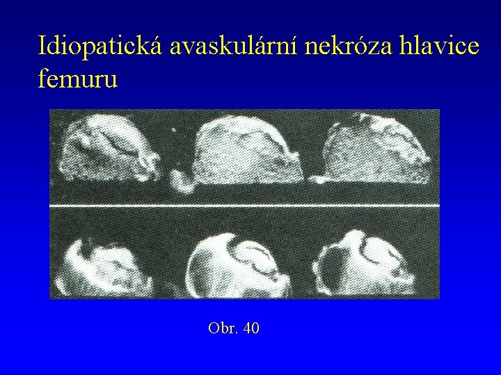 Idiopatická avaskulární nekróza hlavice femuru Obr. 40 