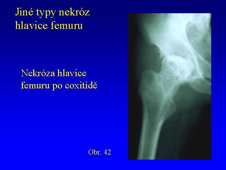 Jiné typy nekróz hlavice femuru Nekróza hlavice femuru po coxitidě Obr. 42 