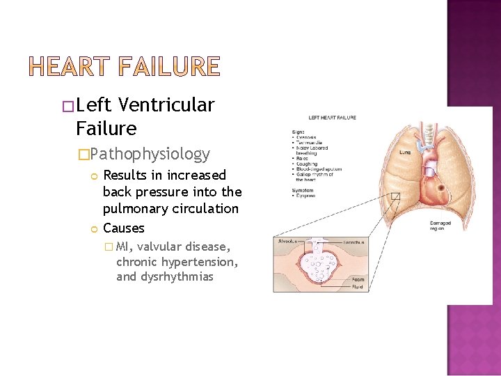 �Left Ventricular Failure �Pathophysiology Results in increased back pressure into the pulmonary circulation Causes