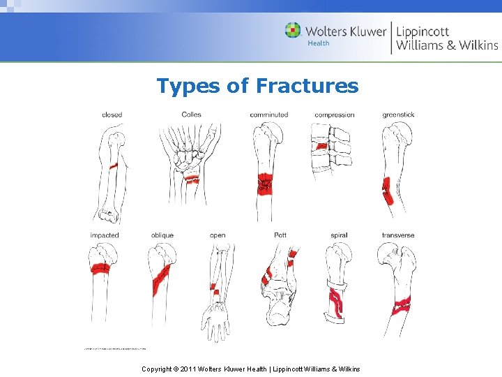 Types of Fractures Copyright © 2011 Wolters Kluwer Health | Lippincott Williams & Wilkins