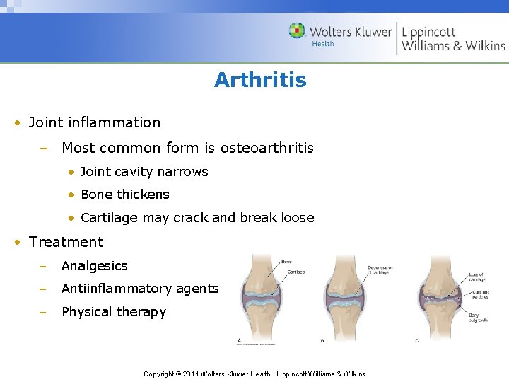 Arthritis • Joint inflammation – Most common form is osteoarthritis • Joint cavity narrows