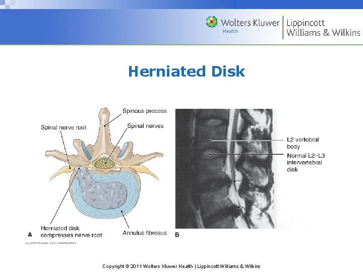 Herniated Disk Copyright © 2011 Wolters Kluwer Health | Lippincott Williams & Wilkins 