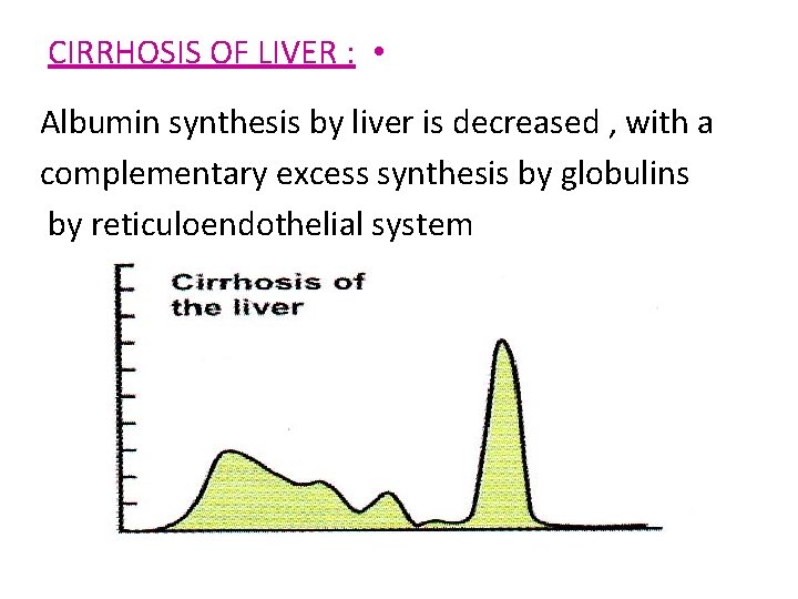 CIRRHOSIS OF LIVER : • Albumin synthesis by liver is decreased , with a