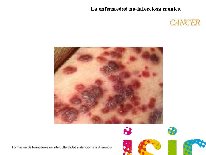 La enfermedad no-infecciosa crónica CANCER 