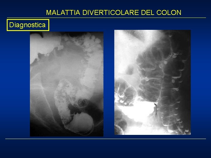 MALATTIA DIVERTICOLARE DEL COLON Diagnostica 