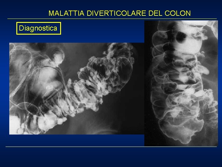 MALATTIA DIVERTICOLARE DEL COLON Diagnostica 