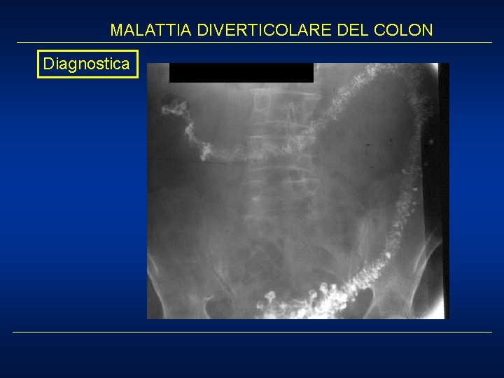 MALATTIA DIVERTICOLARE DEL COLON Diagnostica 