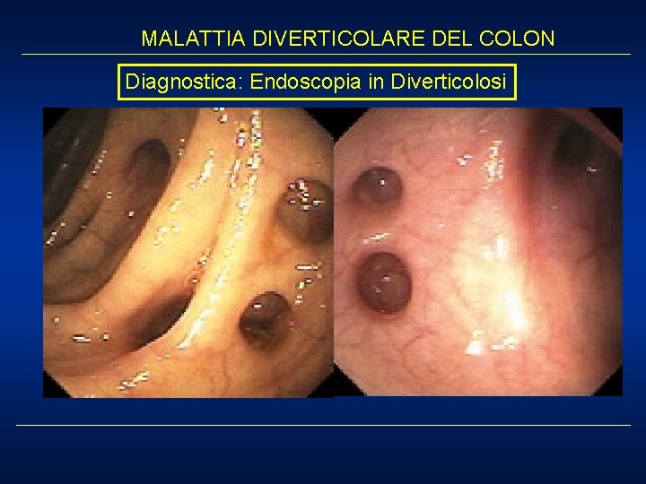 MALATTIA DIVERTICOLARE DEL COLON Diagnostica: Endoscopia in Diverticolosi 
