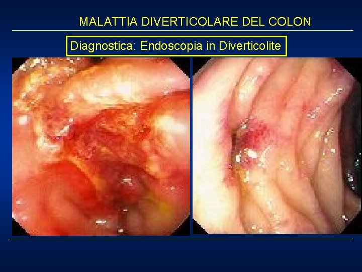 MALATTIA DIVERTICOLARE DEL COLON Diagnostica: Endoscopia in Diverticolite 