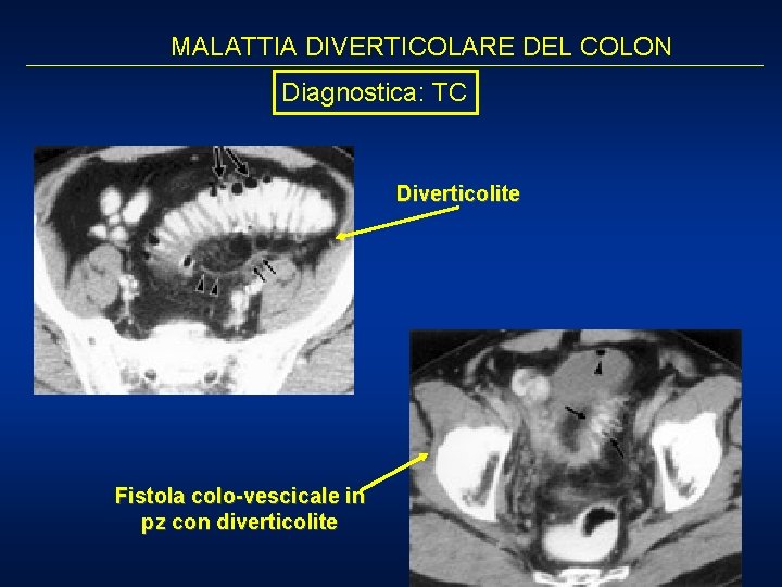 MALATTIA DIVERTICOLARE DEL COLON Diagnostica: TC Diverticolite Fistola colo-vescicale in pz con diverticolite 