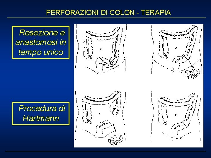 PERFORAZIONI DI COLON - TERAPIA Resezione e anastomosi in tempo unico Procedura di Hartmann