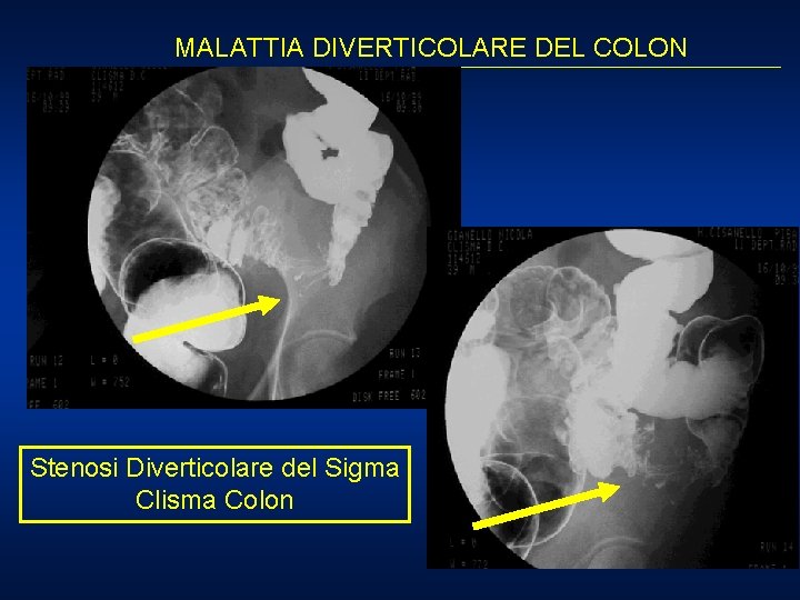 MALATTIA DIVERTICOLARE DEL COLON Stenosi Diverticolare del Sigma Clisma Colon 