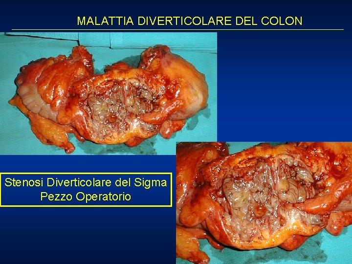 MALATTIA DIVERTICOLARE DEL COLON Stenosi Diverticolare del Sigma Pezzo Operatorio 