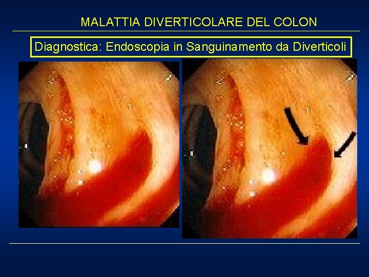 MALATTIA DIVERTICOLARE DEL COLON Diagnostica: Endoscopia in Sanguinamento da Diverticoli 