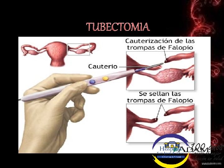TUBECTOMIA 