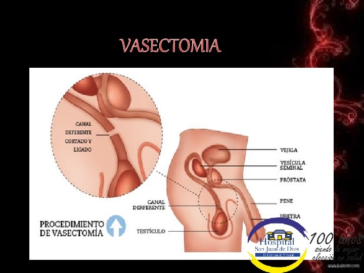 VASECTOMIA 