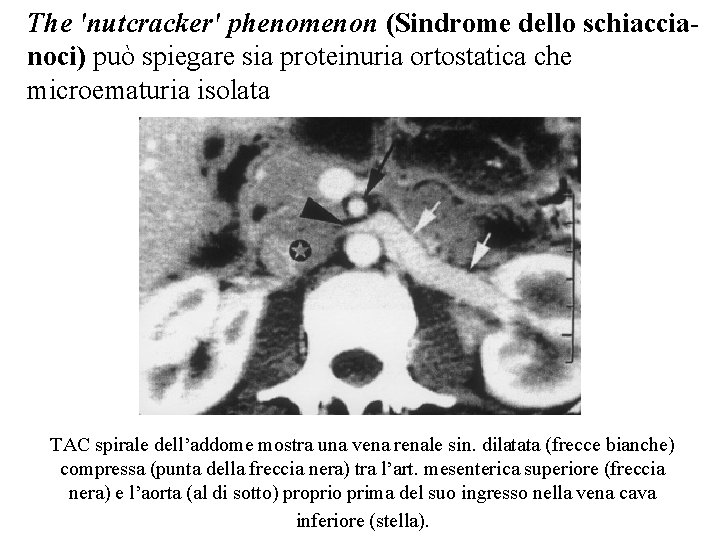 The 'nutcracker' phenomenon (Sindrome dello schiaccianoci) può spiegare sia proteinuria ortostatica che microematuria isolata
