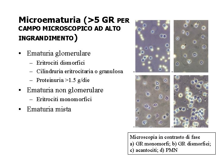 Microematuria (>5 GR PER CAMPO MICROSCOPICO AD ALTO INGRANDIMENTO) • Ematuria glomerulare – Eritrociti