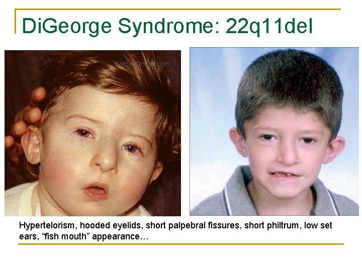 Di. George Syndrome: 22 q 11 del Hypertelorism, hooded eyelids, short palpebral fissures, short
