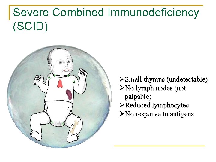 Severe Combined Immunodeficiency (SCID) ØSmall thymus (undetectable) ØNo lymph nodes (not palpable) ØReduced lymphocytes