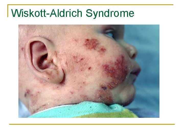 Wiskott-Aldrich Syndrome 